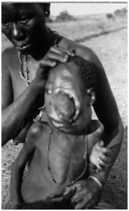 Burkitt's Lymphoma photo from 1935